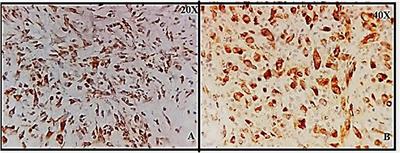 Elevated Neurokinin-1 Receptor Expression in Uterine Products of Conception Is Associated With First Trimester Miscarriages